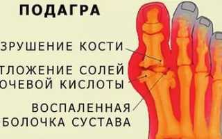 Что с почками при подагре