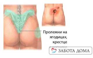 У лежачего больного пролежень на копчике