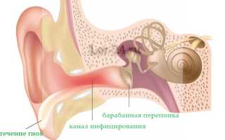 Острый наружный отит стандарты оказания медицинской помощи