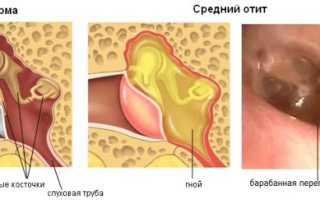 Шунт в ухо при отите у взрослых