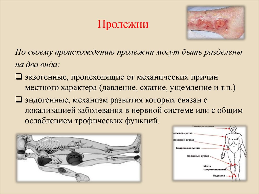 Что такое пролежни