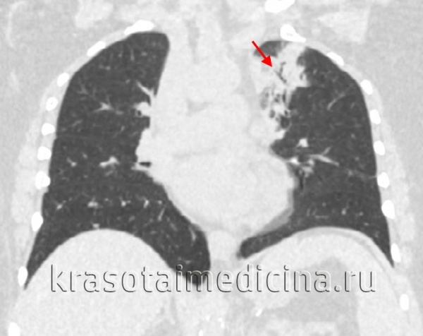 КТ ОГК. Участок пневмонической инфильтрации в верхней доле левого легкого.