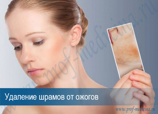 Убрать следы от ожогов лазером