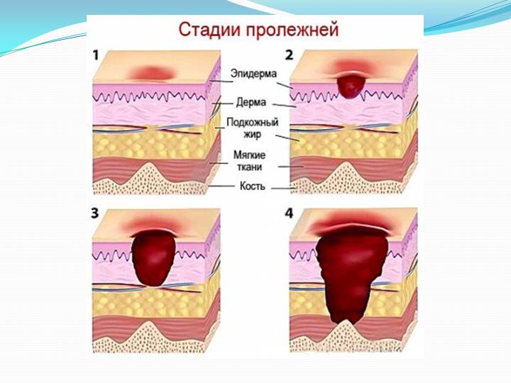 Глубокие пролежни на крестце фото thumbnail