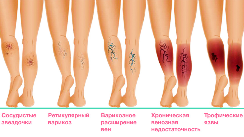 Трофические язвы. Лечение. Стерильно.com