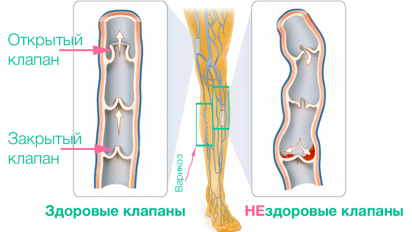 Венозные клапаны. Трофические язвы. Стерильно.com