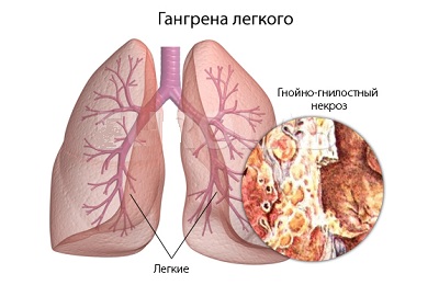 Гангрена легкого