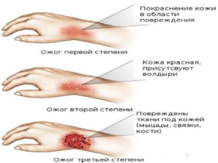 Презентация на тему первая помощь при ожогах и обморожениях скачать