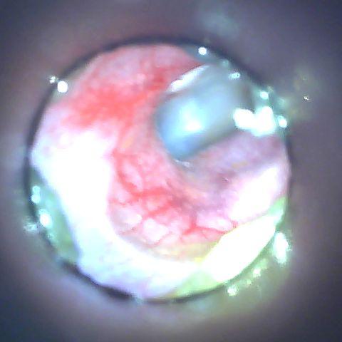 otitis