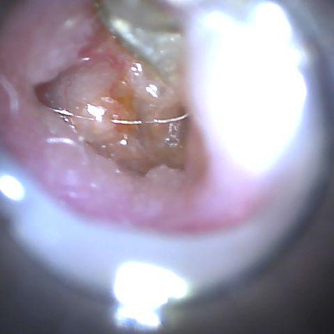 clean ear