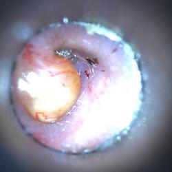 abscess