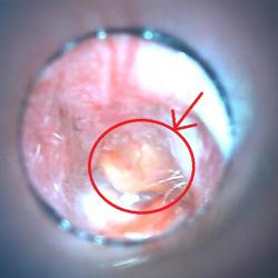 abscess1