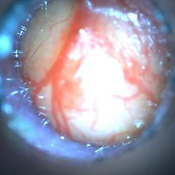 abscess2