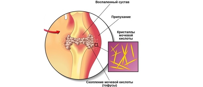 Упражнения при подагре для стопы thumbnail