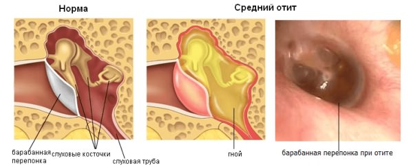 показания к шунтированию