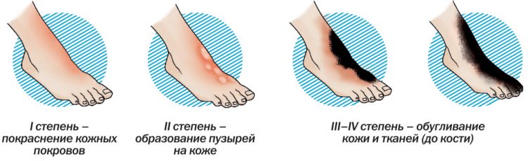 При ожоге кипятком мази на волдырь